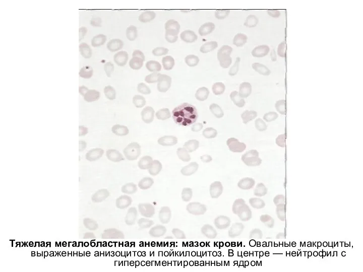 Тяжелая мегалобластная анемия: мазок крови. Овальные макроциты, выраженные анизоцитоз и пойкилоцитоз.