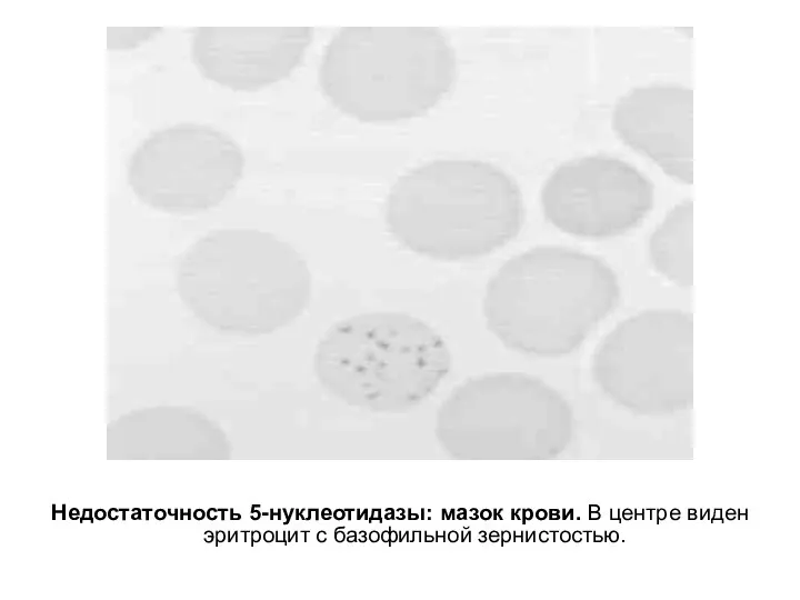 Недостаточность 5-нуклеотидазы: мазок крови. В центре виден эритроцит с базофильной зернистостью.