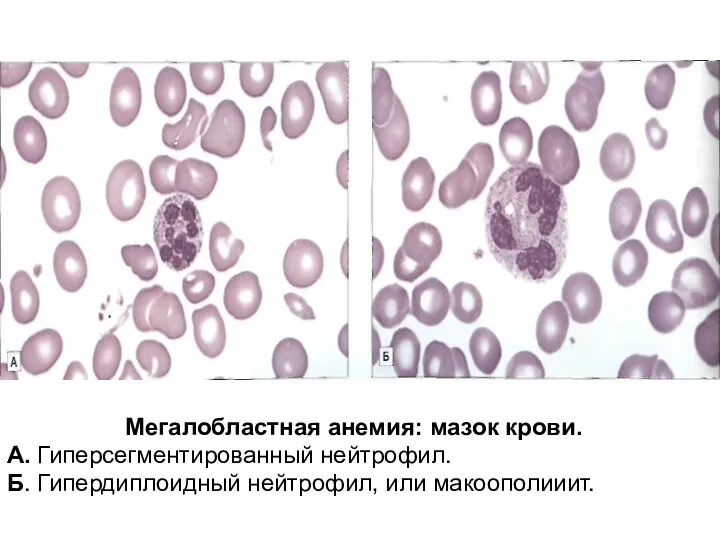 Мегалобластная анемия: мазок крови. А. Гиперсегментированный нейтрофил. Б. Гипердиплоидный нейтрофил, или макоополииит.