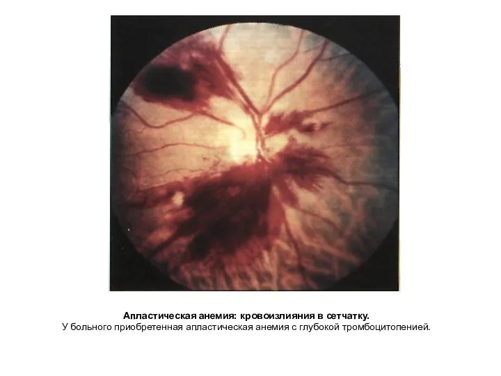 Апластическая анемия: кровоизлияния в сетчатку. У больного приобретенная апластическая анемия с глубокой тромбоцитопенией.