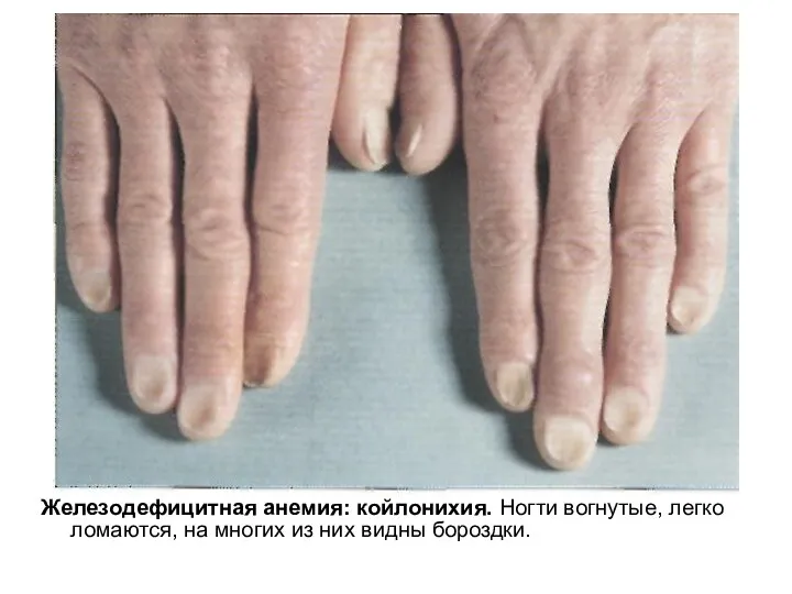 Железодефицитная анемия: койлонихия. Ногти вогнутые, легко ломаются, на многих из них видны бороздки.