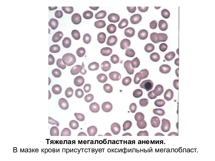 Тяжелая мегалобластная анемия. В мазке крови присутствует оксифильный мегалобласт.