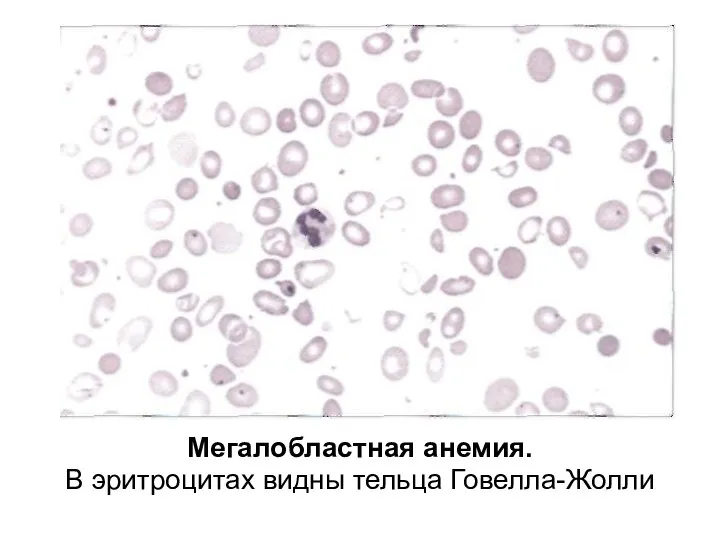Мегалобластная анемия. В эритроцитах видны тельца Говелла-Жолли