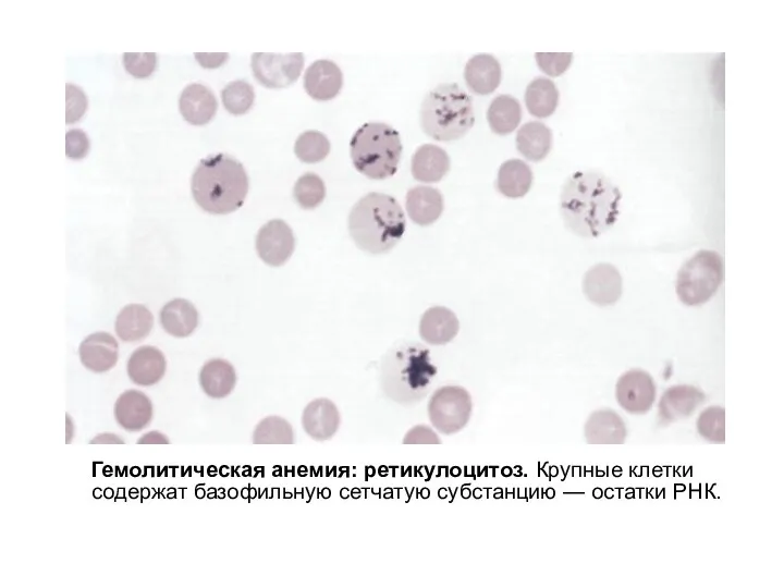 Гемолитическая анемия: ретикулоцитоз. Крупные клетки содержат базофильную сетчатую субстанцию — остатки РНК.