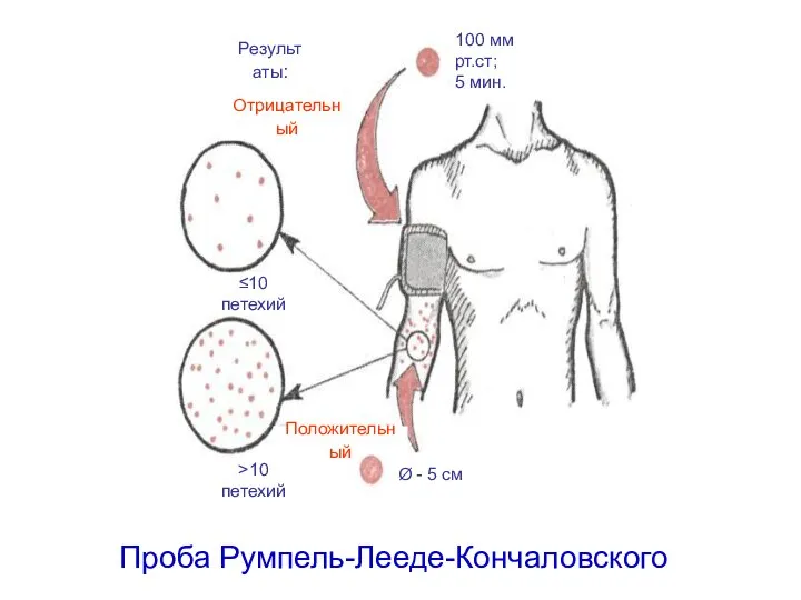 Проба Румпель-Лееде-Кончаловского Ø - 5 см 100 мм рт.ст; 5 мин.