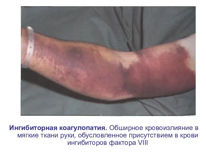 Ингибиторная коагулопатия. Обширное кровоизлияние в мягкие ткани руки, обусловленное присутствием в крови ингибиторов фактора VIII