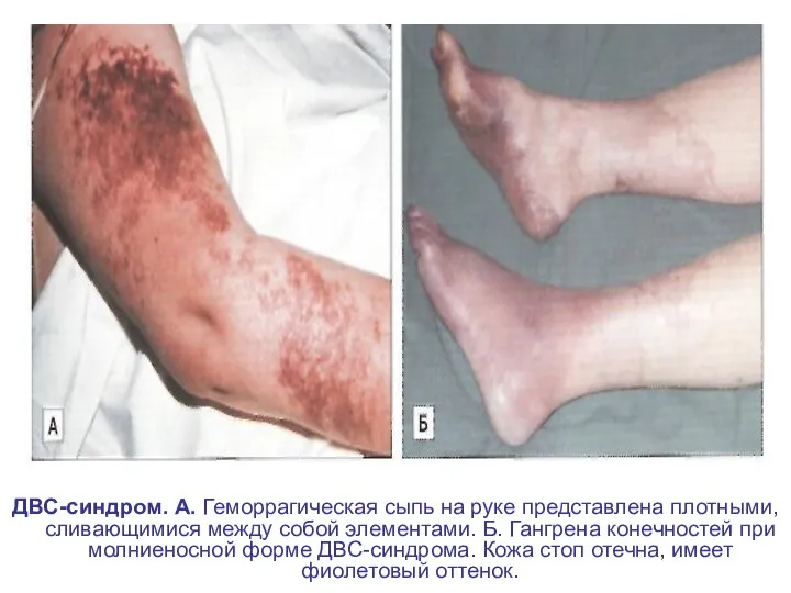 ДВС-синдром. А. Геморрагическая сыпь на руке представлена плотными, сливающимися между собой