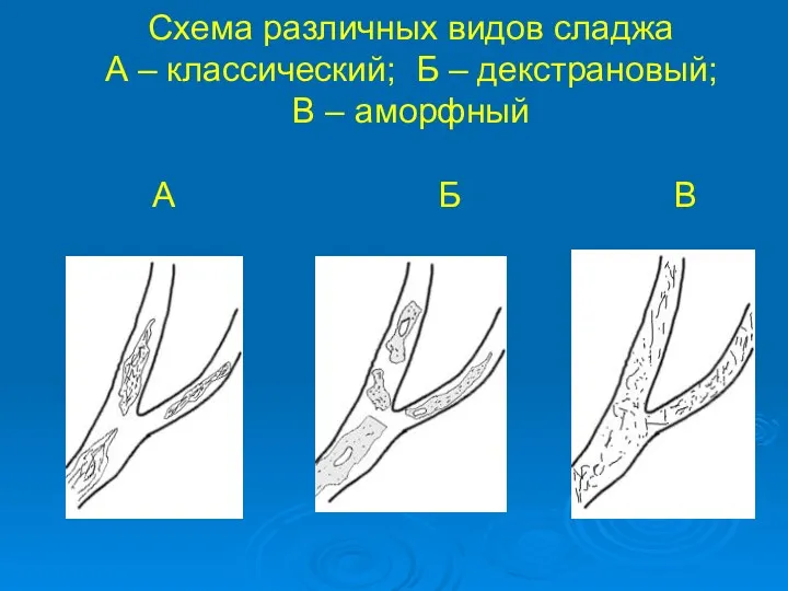 Схема различных видов сладжа А – классический; Б – декстрановый; В – аморфный А Б В