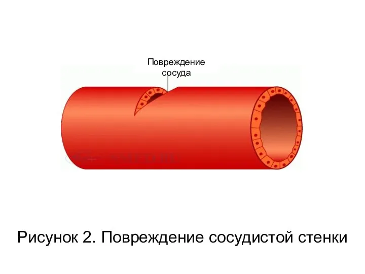 Рисунок 2. Повреждение сосудистой стенки Повреждение сосуда