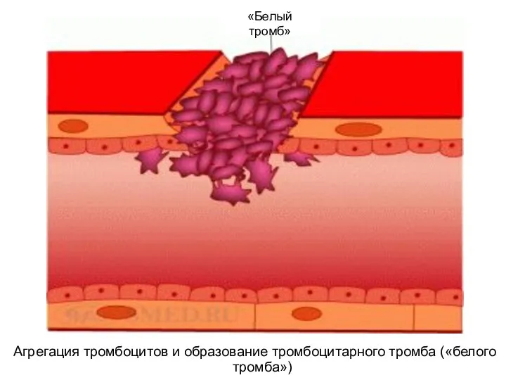 Агрегация тромбоцитов и образование тромбоцитарного тромба («белого тромба») «Белый тромб»