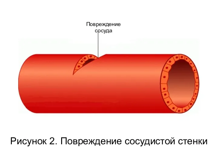 Рисунок 2. Повреждение сосудистой стенки Повреждение сосуда