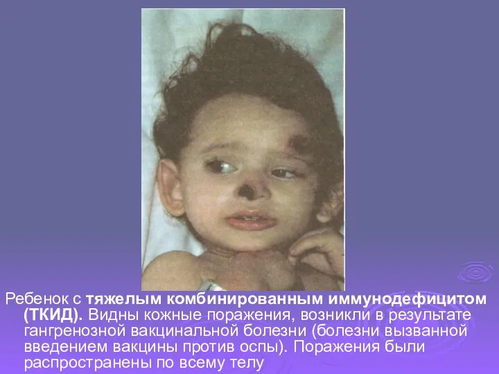 Ребенок с тяжелым комбинированным иммунодефицитом (ТКИД). Видны кожные поражения, возникли в