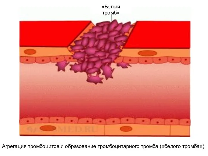 Агрегация тромбоцитов и образование тромбоцитарного тромба («белого тромба») «Белый тромб»
