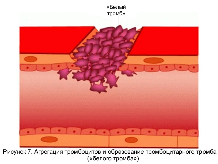 Рисунок 7. Агрегация тромбоцитов и образование тромбоцитарного тромба («белого тромба») «Белый тромб»
