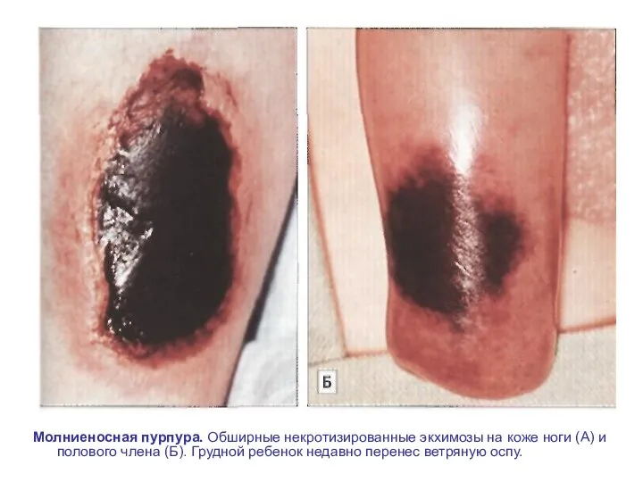 Молниеносная пурпура. Обширные некротизированные экхимозы на коже ноги (А) и полового