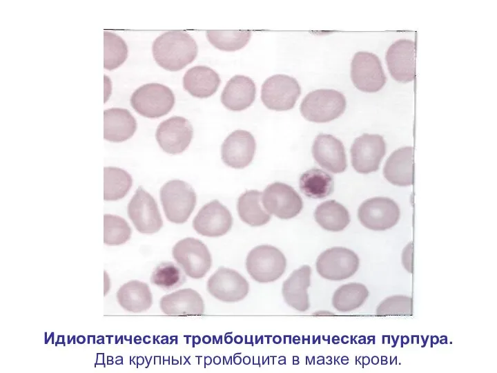 Идиопатическая тромбоцитопеническая пурпура. Два крупных тромбоцита в мазке крови.