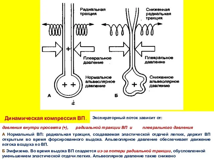 Динамическая компрессия ВП. Экспираторный поток зависит от: давления внутри просвета (+),