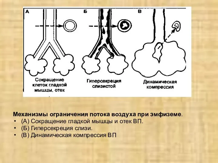 Механизмы ограничения потока воздуха при эмфиземе. (А) Сокращение гладкой мышцы и