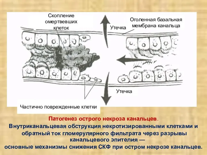 Патогенез острого некроза канальцев. Внутриканальцевая обструкция некротизированными клетками и обратный ток