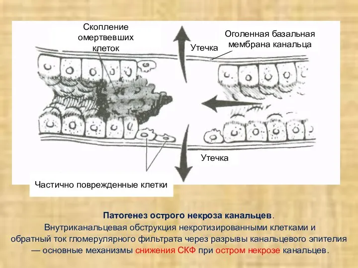 Патогенез острого некроза канальцев. Внутриканальцевая обструкция некротизированными клетками и обратный ток