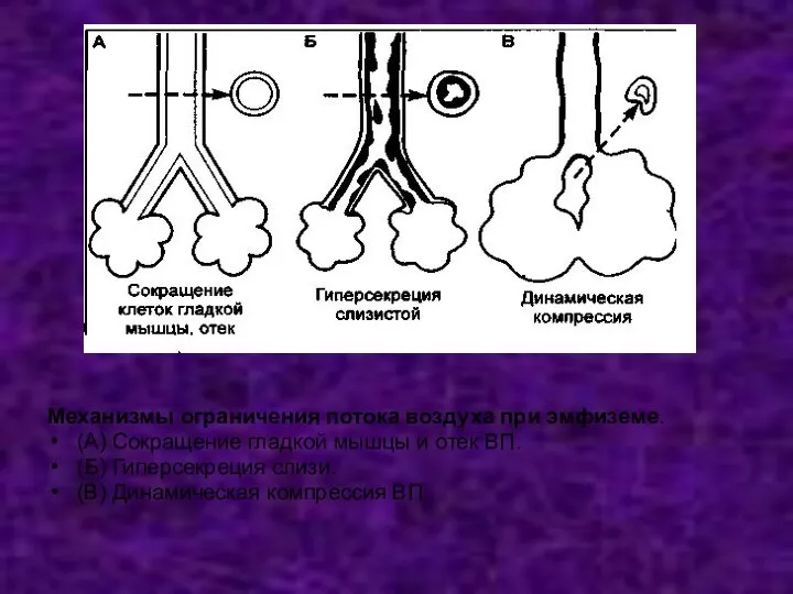 Механизмы ограничения потока воздуха при эмфиземе. (А) Сокращение гладкой мышцы и