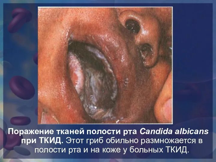 Поражение тканей полости рта Candida albicans при ТКИД. Этот гриб обильно