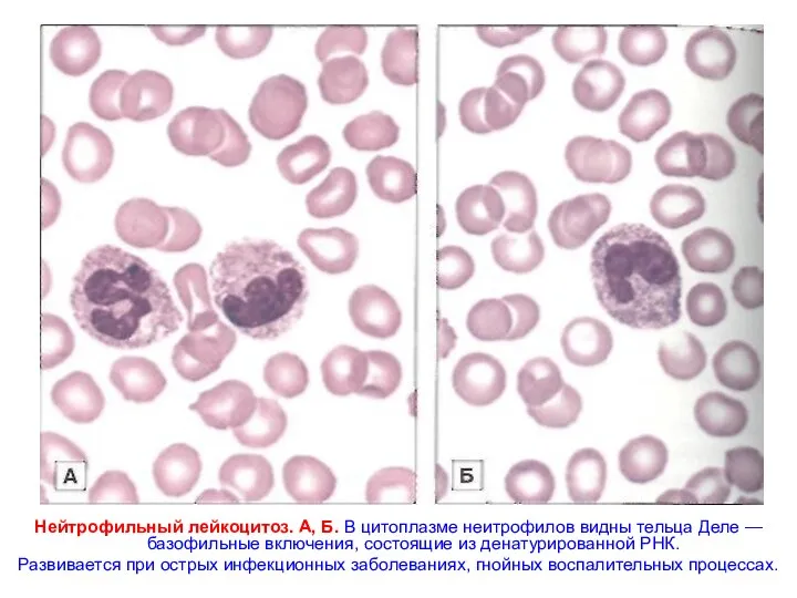 Нейтрофильный лейкоцитоз. А, Б. В цитоплазме неитрофилов видны тельца Деле —
