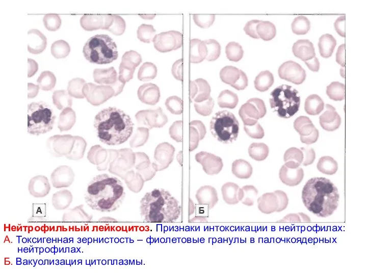 Нейтрофильный лейкоцитоз. Признаки интоксикации в нейтрофилах: А. Токсигенная зернистость – фиолетовые