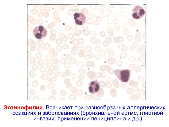 Эозинофилия. Возникает при разнообразных аллергических реакциях и заболеваниях (бронхиальной астме, глистной инвазии, применении пенициллина и др.)