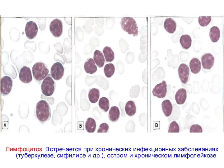 Лимфоцитоз. Встречается при хронических инфекционных заболеваниях (туберкулезе, сифилисе и др.), остром и хроническом лимфолейкозе