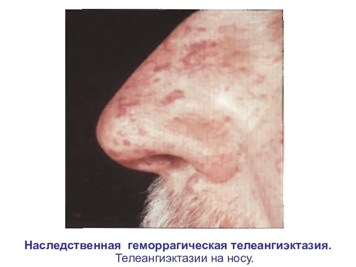 Наследственная геморрагическая телеангиэктазия. Телеангиэктазии на носу.