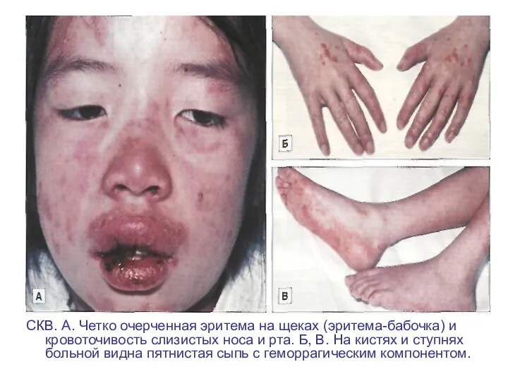СКВ. А. Четко очерченная эритема на щеках (эритема-бабочка) и кровоточивость слизистых