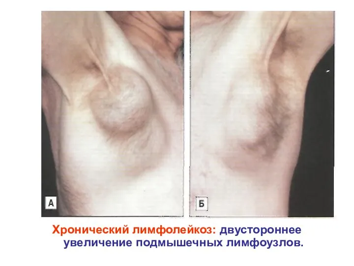 Хронический лимфолейкоз: двустороннее увеличение подмышечных лимфоузлов.