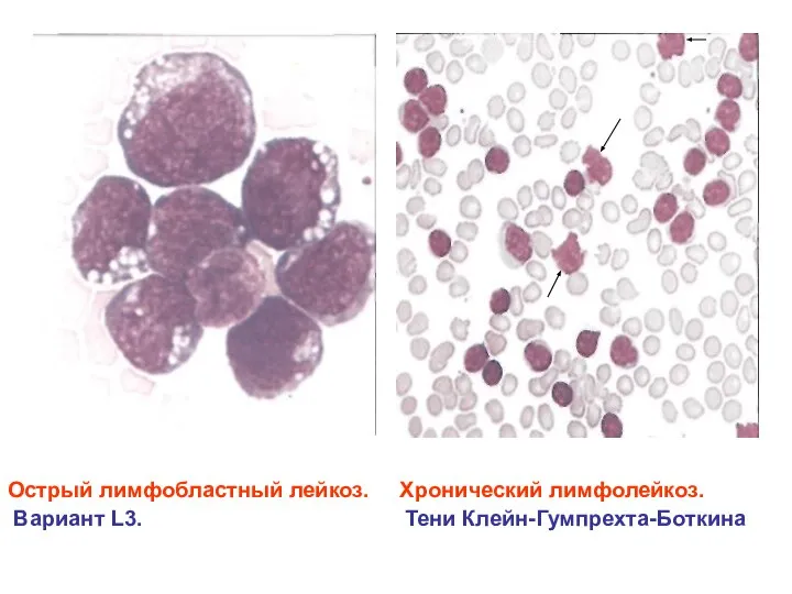Острый лимфобластный лейкоз. Хронический лимфолейкоз. Вариант L3. Тени Клейн-Гумпрехта-Боткина