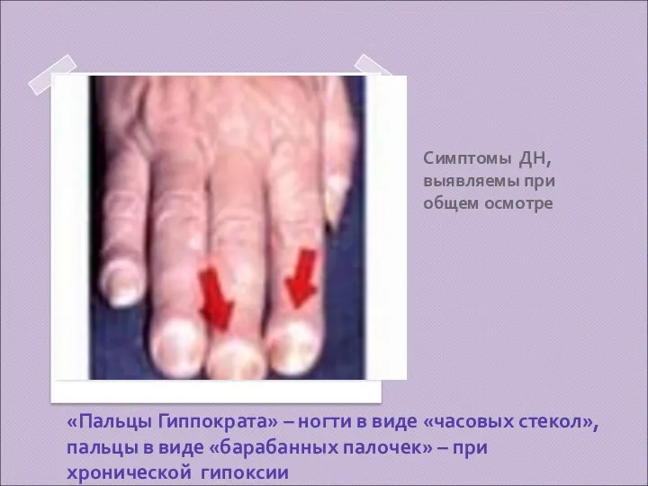 Симптомы ДН, выявляемы при общем осмотре «Пальцы Гиппократа» – ногти в