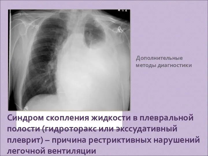 Дополнительные методы диагностики Синдром скопления жидкости в плевральной полости (гидроторакс или