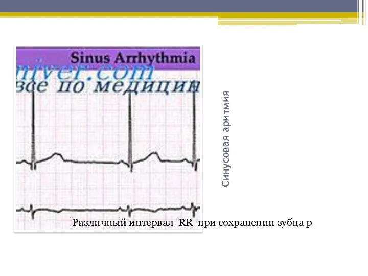 Синусовая аритмия Различный интервал RR при сохранении зубца р