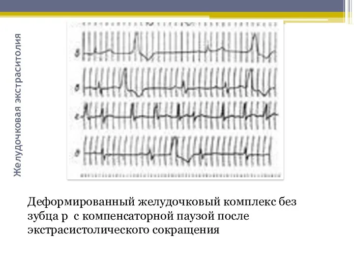 Желудочковая экстраситолия Деформированный желудочковый комплекс без зубца р с компенсаторной паузой после экстрасистолического сокращения