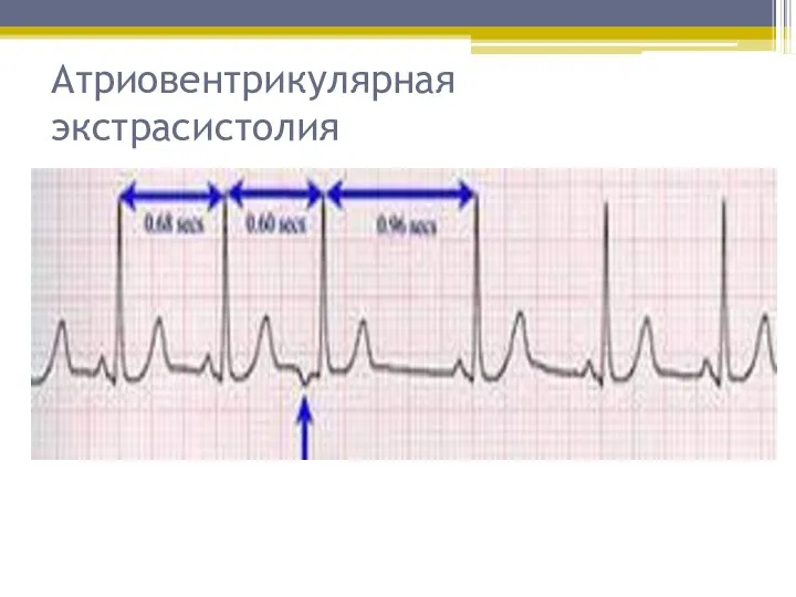 Атриовентрикулярная экстрасистолия