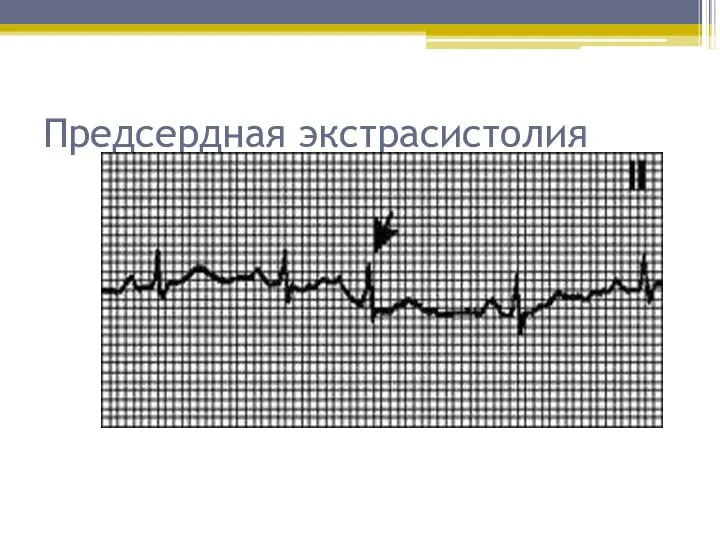 Предсердная экстрасистолия