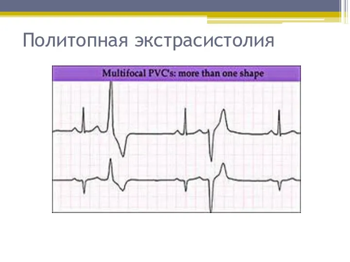 Политопная экстрасистолия