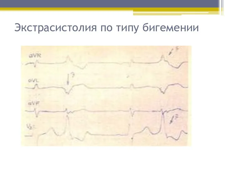 Экстрасистолия по типу бигемении