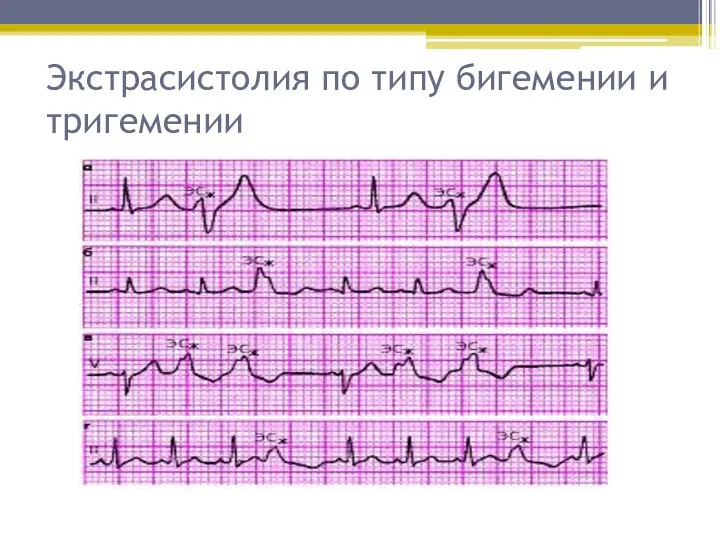 Экстрасистолия по типу бигемении и тригемении