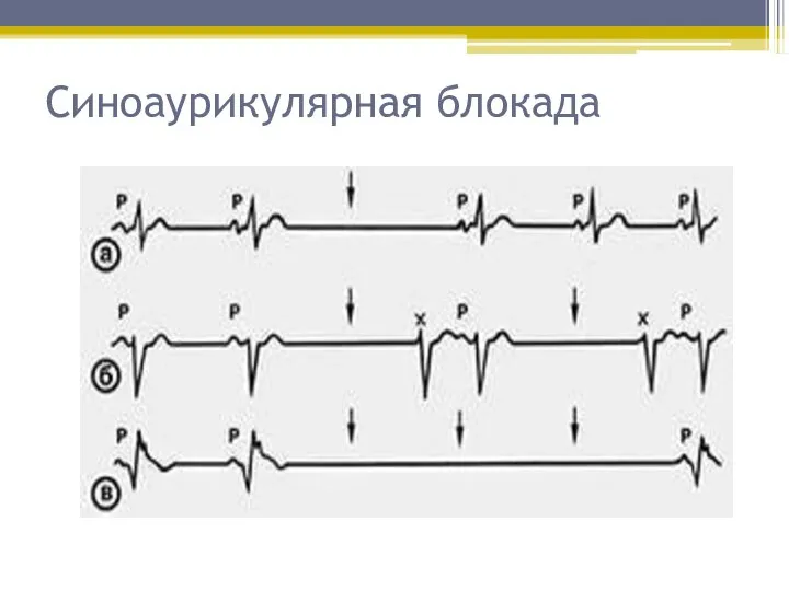 Синоаурикулярная блокада