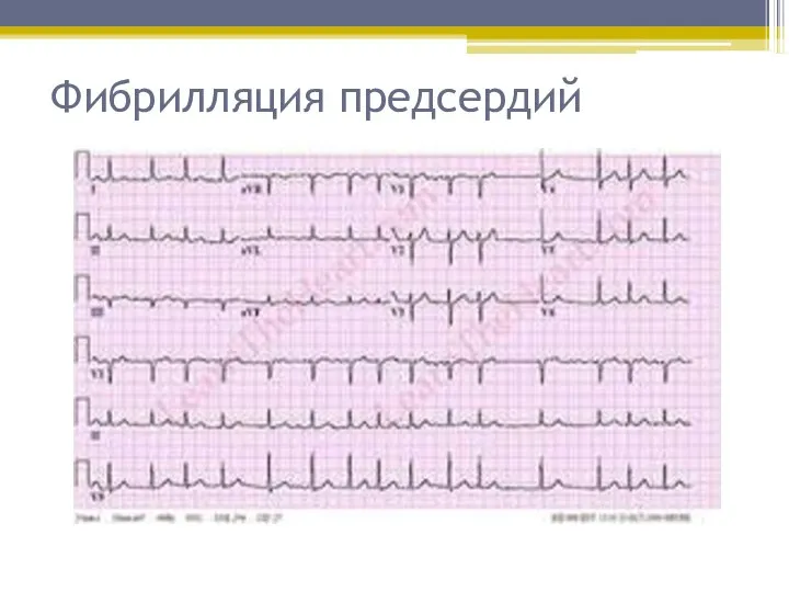 Фибрилляция предсердий