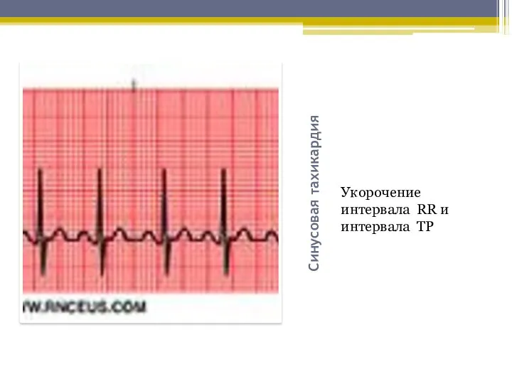 Синусовая тахикардия Укорочение интервала RR и интервала TP