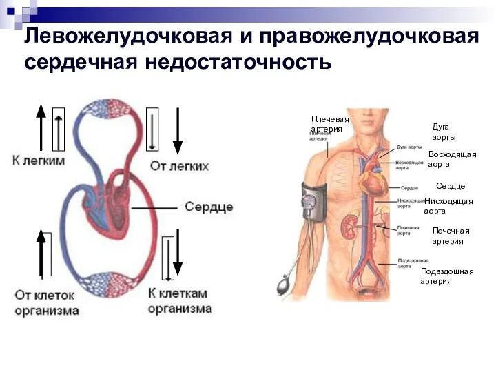 Левожелудочковая и правожелудочковая сердечная недостаточность Почечная артерия Подвздошная артерия Нисходящая аорта