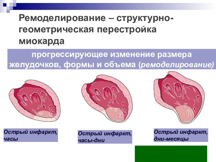 прогрессирующее изменение размера желудочков, формы и объема (ремоделирование) Ремоделирование – структурно-геометрическая