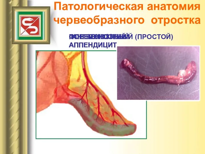 Патологическая анатомия червеобразного отростка ПОВЕРХНОСТНЫЙ (ПРОСТОЙ) АППЕНДИЦИТ ФЛЕГМОНОЗНЫЙ АППЕНДИЦИТ ГАНГРЕНОЗНЫЙ АППЕНДИЦИТ