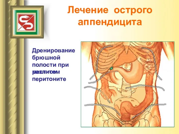 Лечение острого аппендицита Дренирование брюшной полости при местном перитоните Дренирование брюшной полости при разлитом перитоните